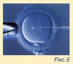 Fig. 5 Sperm injecting inside of oocyte under the microscope (ICSI).